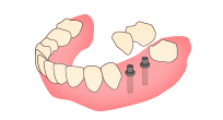 インプラント入れ歯