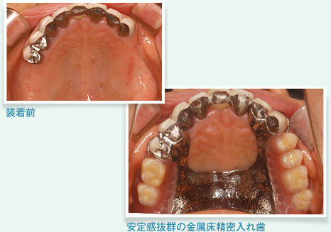 安定度抜群の金属床精密入れ歯