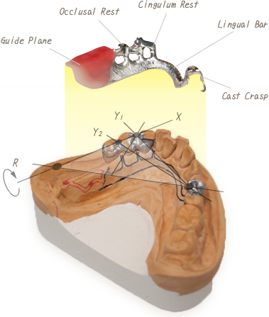 構造設計された入れ歯製作